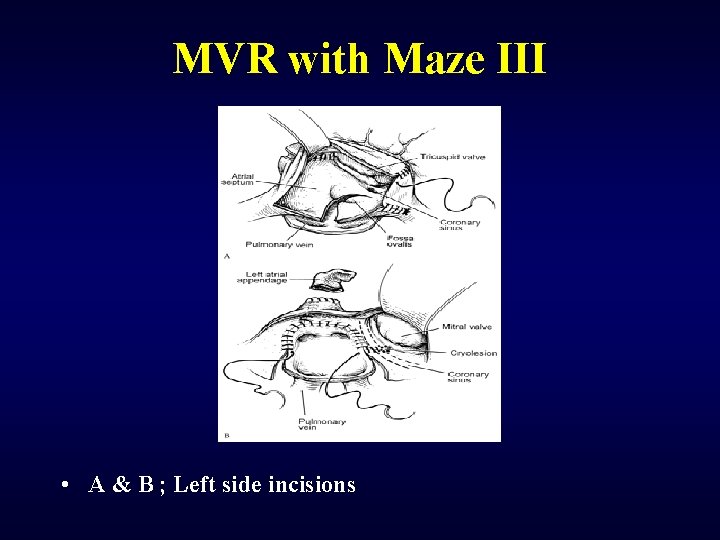 MVR with Maze III • A & B ; Left side incisions 