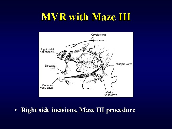 MVR with Maze III • Right side incisions, Maze III procedure 