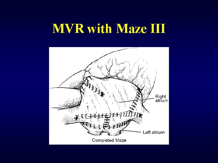 MVR with Maze III 
