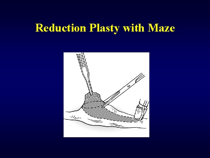 Reduction Plasty with Maze 