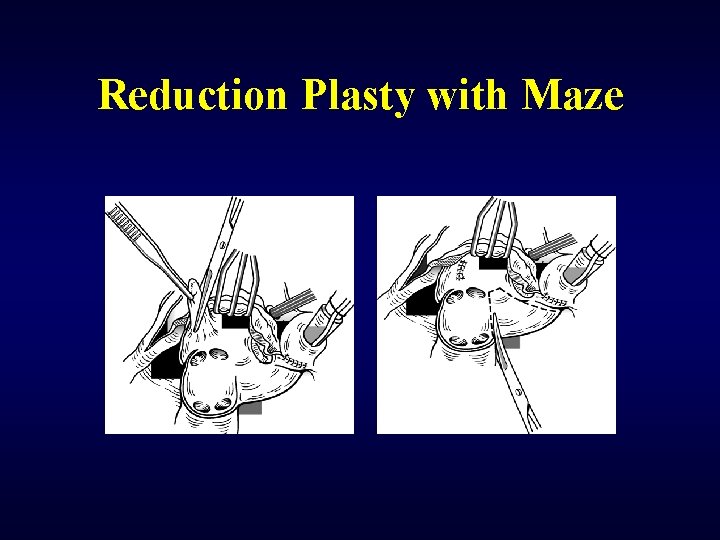 Reduction Plasty with Maze 