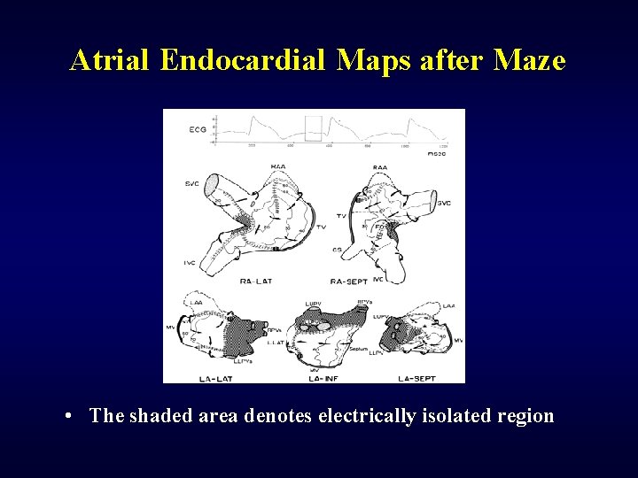Atrial Endocardial Maps after Maze • The shaded area denotes electrically isolated region 