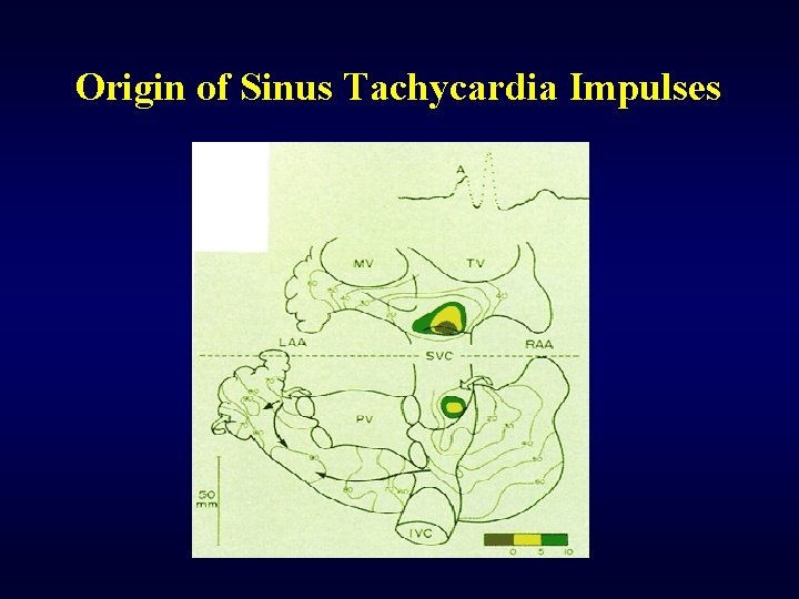 Origin of Sinus Tachycardia Impulses 