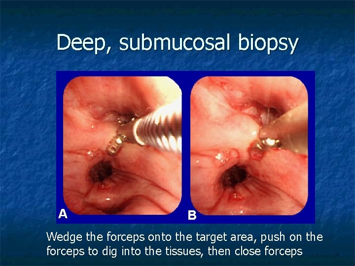 Deep, submucosal biopsy A B Wedge the forceps onto the target area, push on