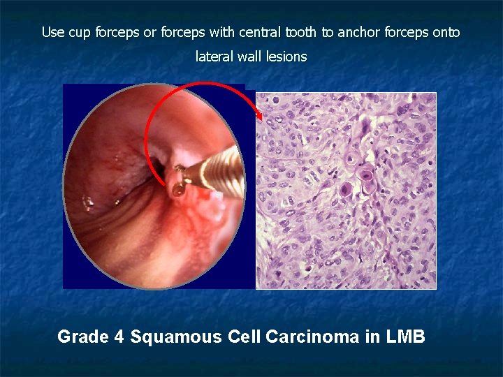 Use cup forceps or forceps with central tooth to anchor forceps onto lateral wall