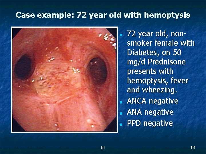 Case example: 72 year old with hemoptysis ■ ■ BI 72 year old, nonsmoker