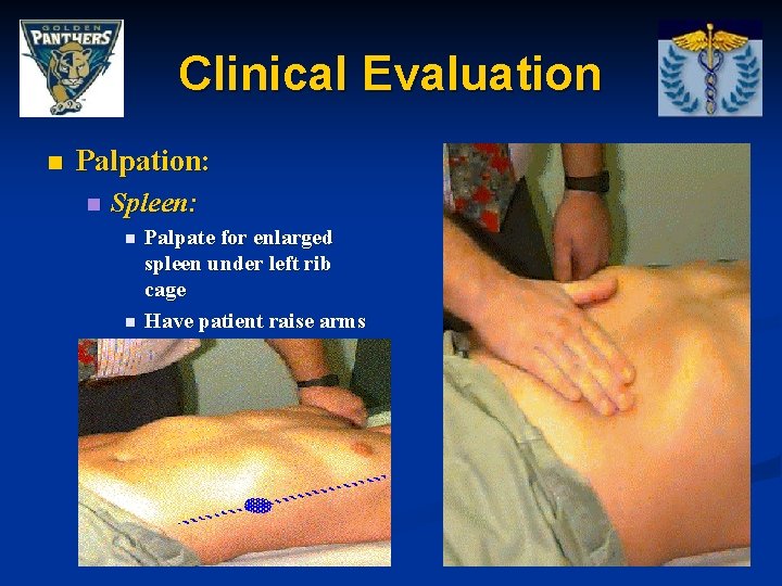 Clinical Evaluation n Palpation: n Spleen: n n Palpate for enlarged spleen under left