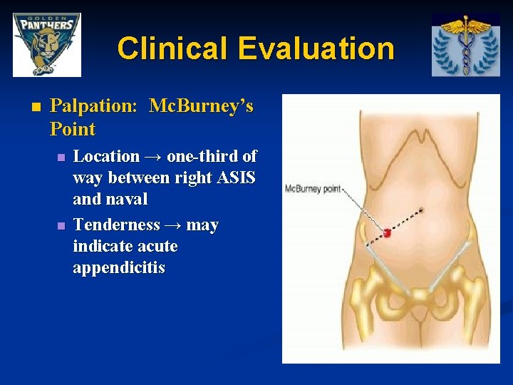 Clinical Evaluation n Palpation: Mc. Burney’s Point n n Location → one-third of way