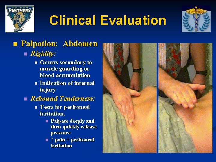 Clinical Evaluation n Palpation: Abdomen n Rigidity: n n n Occurs secondary to muscle