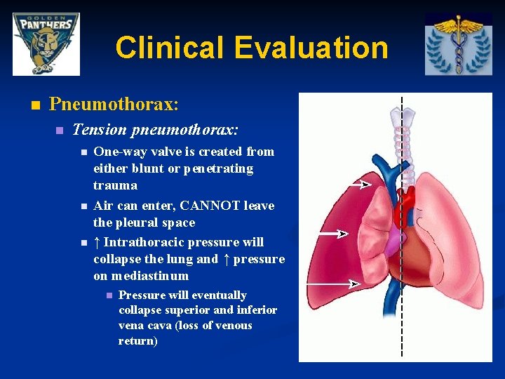 Clinical Evaluation n Pneumothorax: n Tension pneumothorax: n n n One-way valve is created