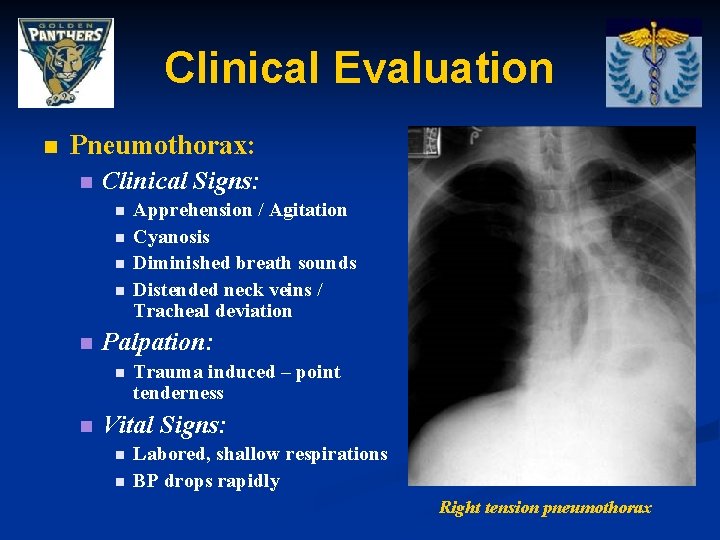 Clinical Evaluation n Pneumothorax: n Clinical Signs: n n n Palpation: n n Apprehension