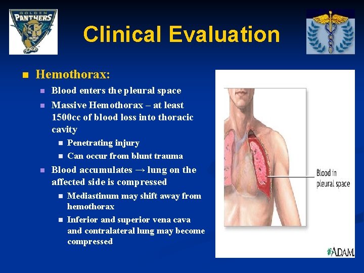 Clinical Evaluation n Hemothorax: n n Blood enters the pleural space Massive Hemothorax –