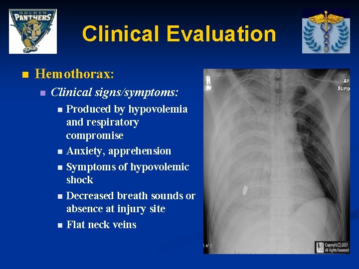 Clinical Evaluation n Hemothorax: n Clinical signs/symptoms: Produced by hypovolemia and respiratory compromise n