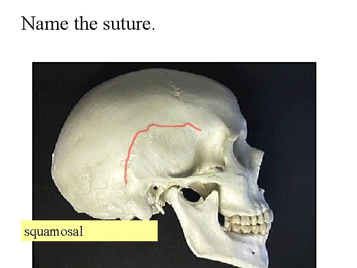 Name the suture. squamosal 