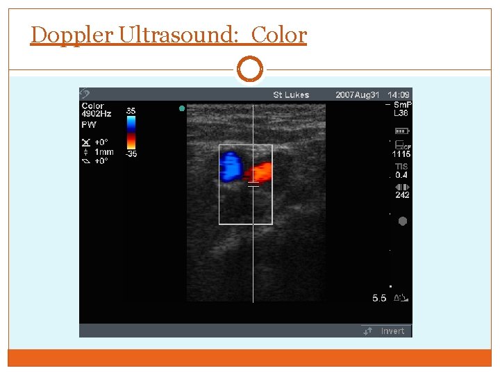 Doppler Ultrasound: Color 