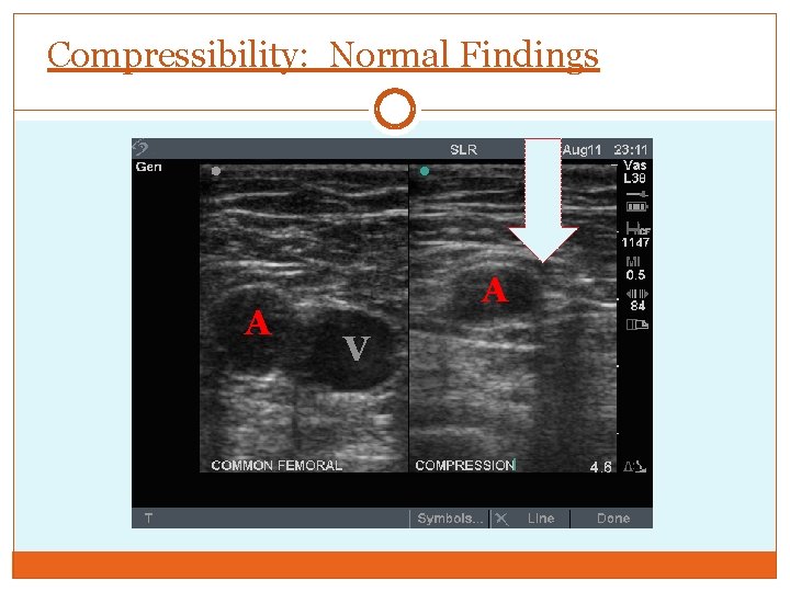 Compressibility: Normal Findings A A V 