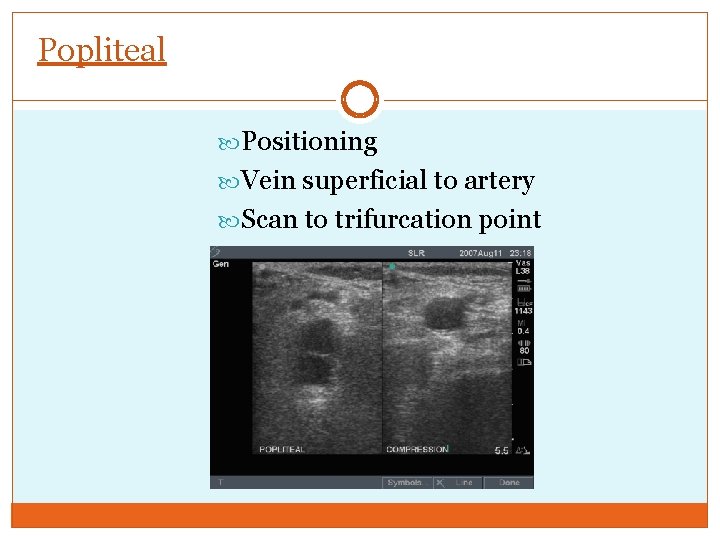 Popliteal Positioning Vein superficial to artery Scan to trifurcation point 