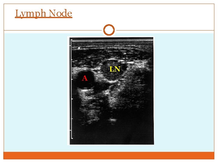 Lymph Node LN A 