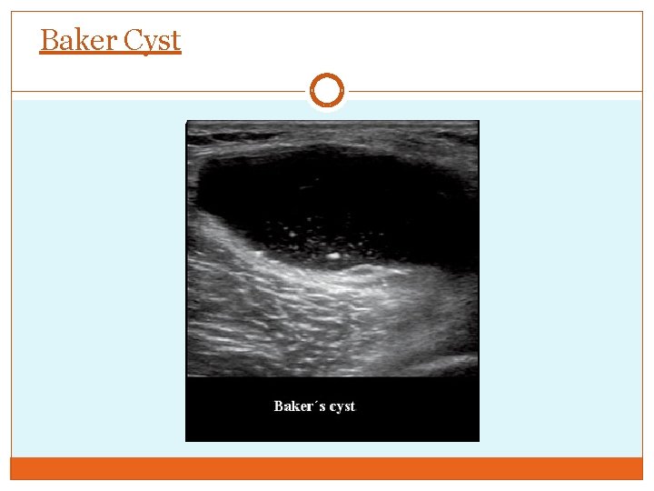 Baker Cyst 
