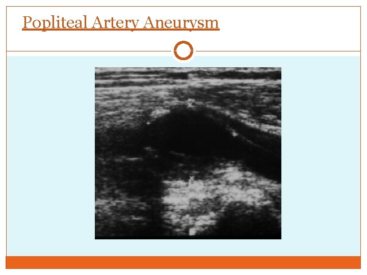 Popliteal Artery Aneurysm 