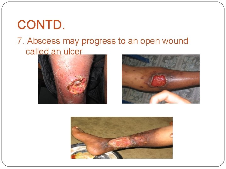 CONTD. 7. Abscess may progress to an open wound called an ulcer 
