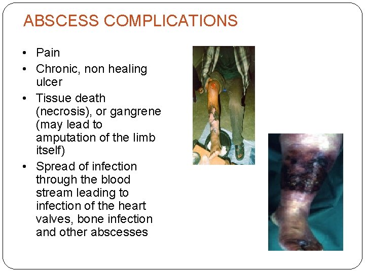 ABSCESS COMPLICATIONS • Pain • Chronic, non healing ulcer • Tissue death (necrosis), or
