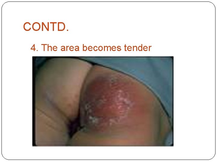 CONTD. 4. The area becomes tender 