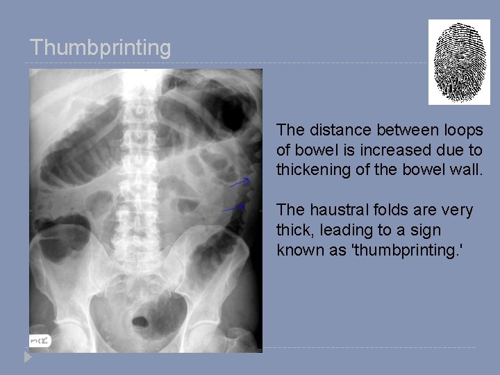 Thumbprinting The distance between loops of bowel is increased due to thickening of the