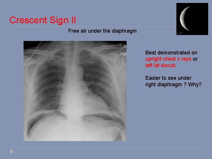 Crescent Sign II Free air under the diaphragm Best demonstrated on upright chest x