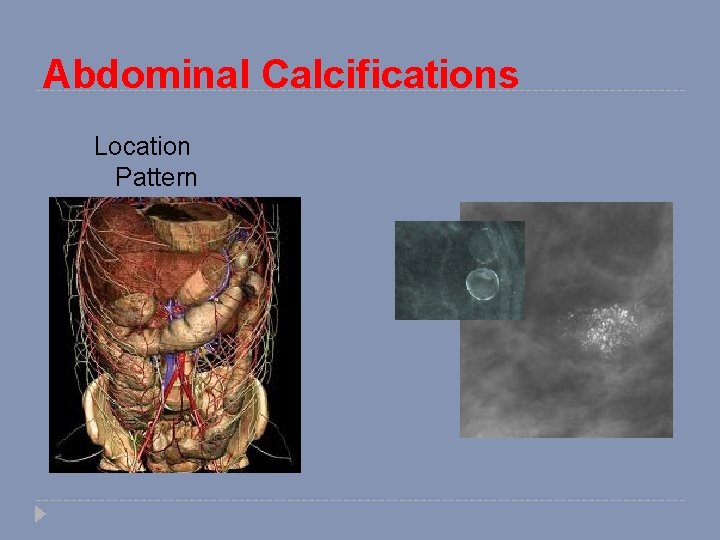 Abdominal Calcifications Location Pattern 