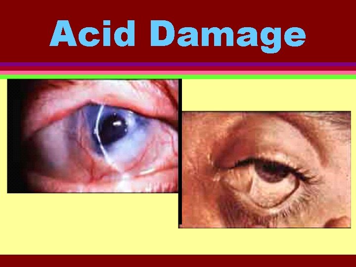 Acid Damage 