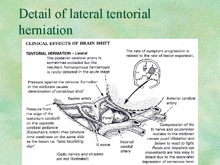 Detail of lateral tentorial herniation 