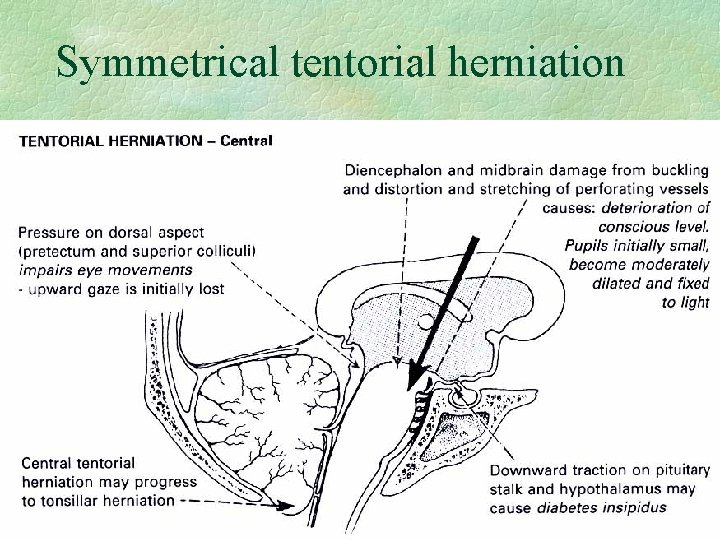 Symmetrical tentorial herniation 