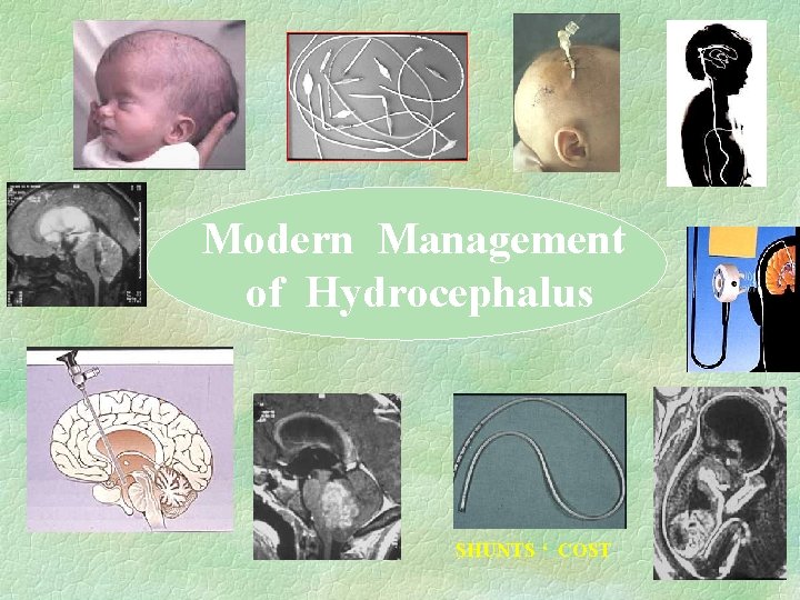 Modern Management of Hydrocephalus SHUNTS ‘ COST 