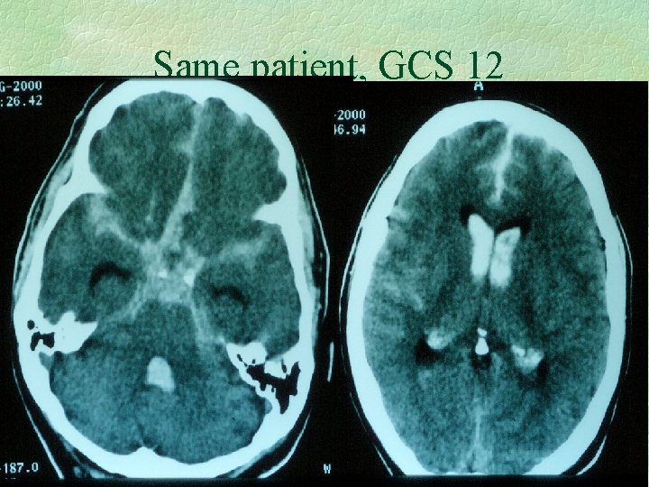 Same patient, GCS 12 