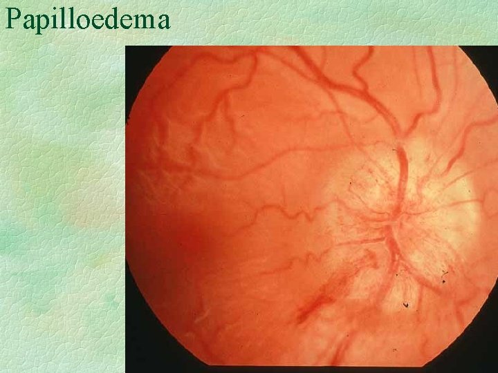 Papilloedema 