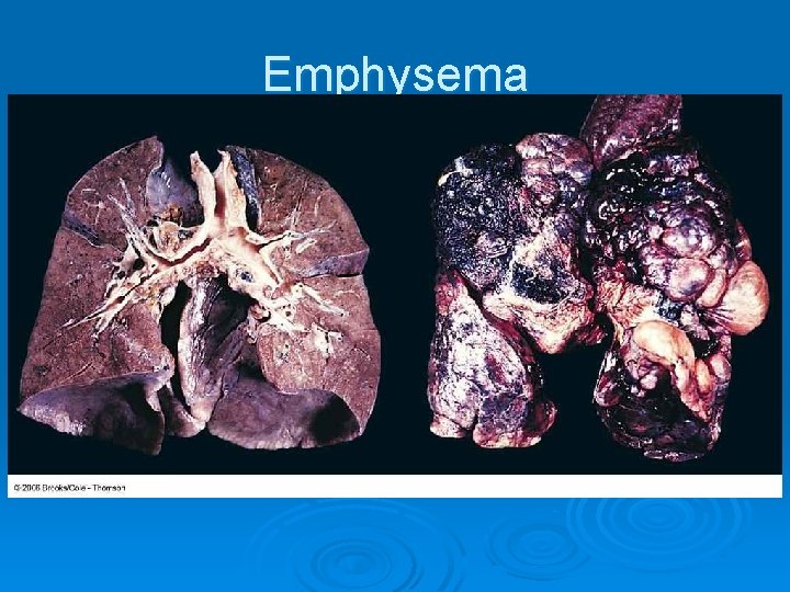 Emphysema 