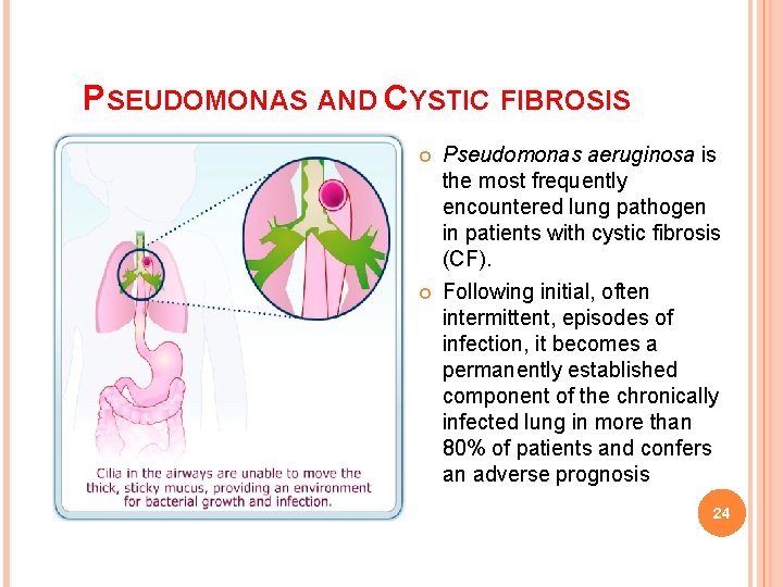 PSEUDOMONAS AND CYSTIC FIBROSIS Pseudomonas aeruginosa is the most frequently encountered lung pathogen in