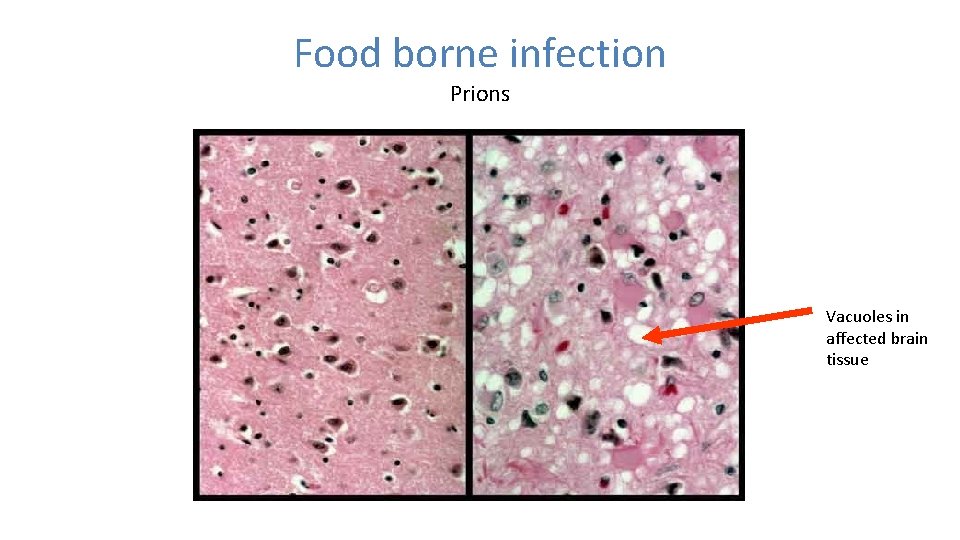 Food borne infection Prions Vacuoles in affected brain tissue 