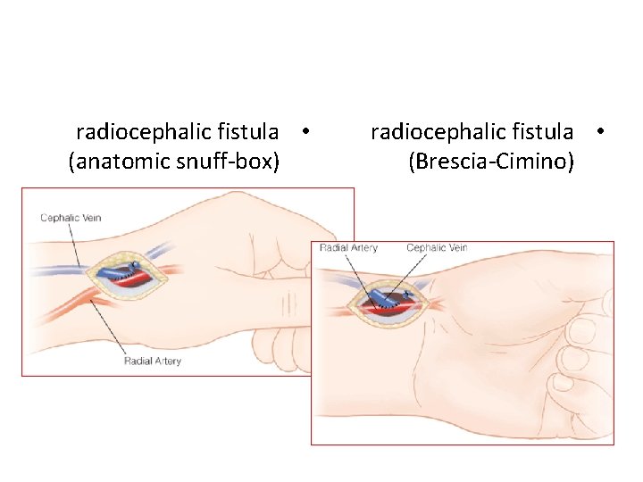 radiocephalic fistula • (anatomic snuff-box) radiocephalic fistula • (Brescia-Cimino) 