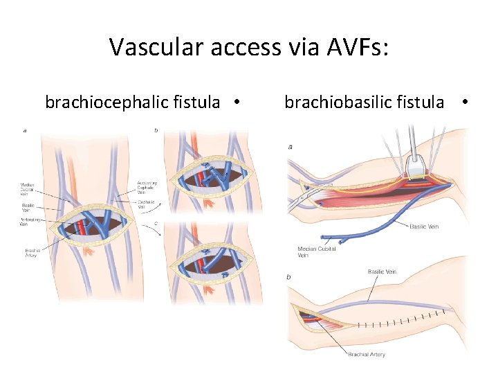 Vascular access via AVFs: brachiocephalic fistula • brachiobasilic fistula • 