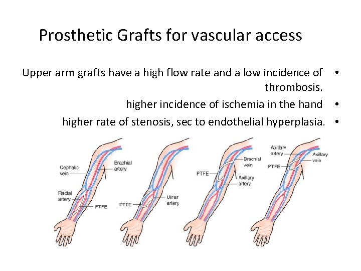 Prosthetic Grafts for vascular access Upper arm grafts have a high flow rate and
