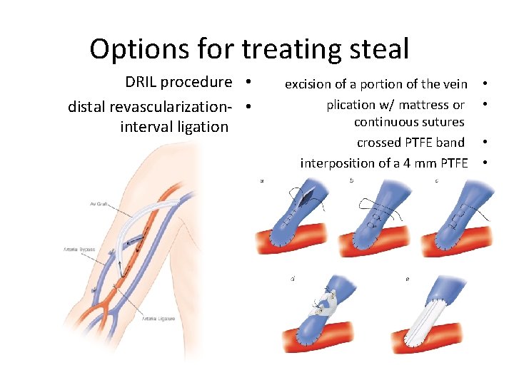 Options for treating steal DRIL procedure • distal revascularization- • interval ligation excision of