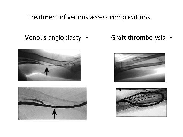 Treatment of venous access complications. Venous angioplasty • Graft thrombolysis • 