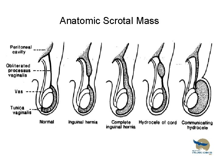 Anatomic Scrotal Mass 