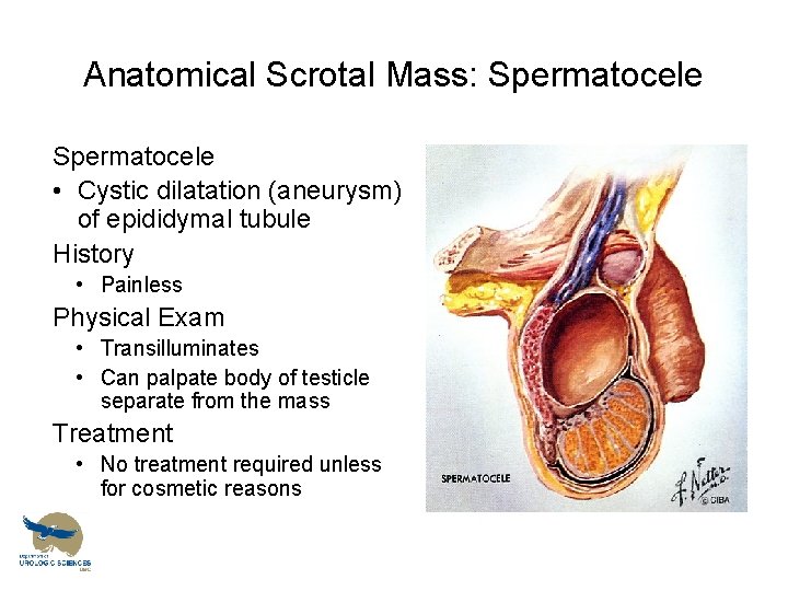 Anatomical Scrotal Mass: Spermatocele • Cystic dilatation (aneurysm) of epididymal tubule History • Painless