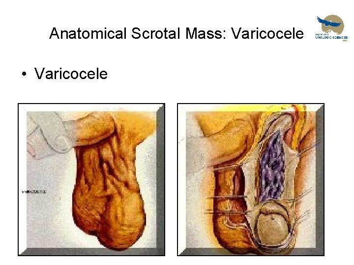 Anatomical Scrotal Mass: Varicocele • Varicocele 