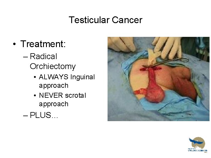 Testicular Cancer • Treatment: – Radical Orchiectomy • ALWAYS Inguinal approach • NEVER scrotal