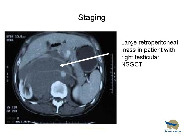 Staging Large retroperitoneal mass in patient with right testicular NSGCT WAG 2002 UBC Phase