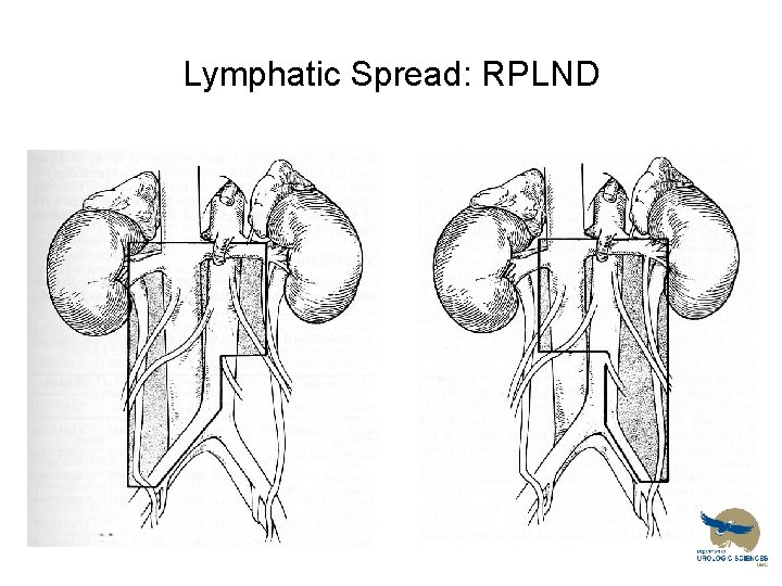 Lymphatic Spread: RPLND 